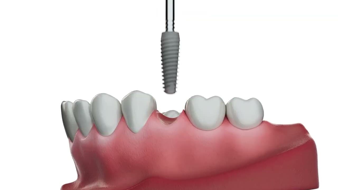 Implant procedure, in 3D