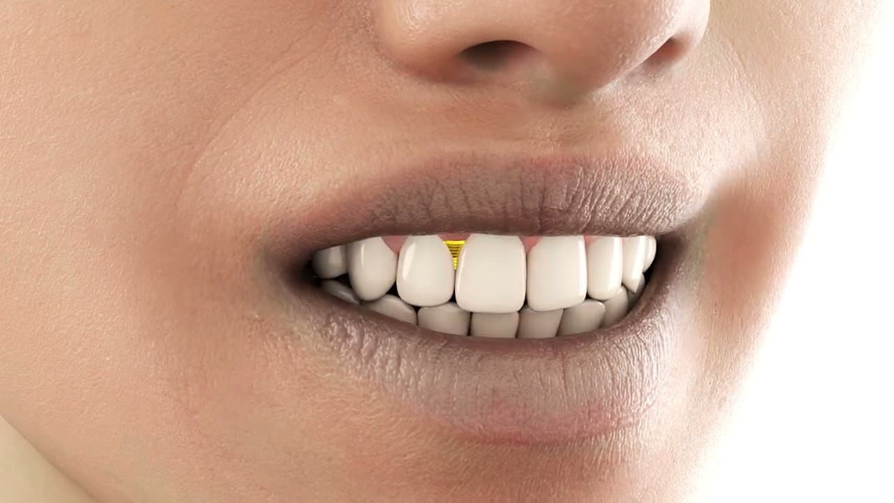 3D dental implant animation